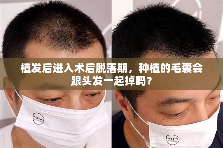 植發后進入術后脫落期，種植的毛囊會跟頭發一起掉嗎？